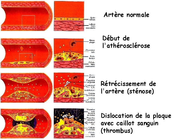 Artère normale Début de l'athérosclérose Rétrécissement de l'artère (sténose) Dislocation de la plaque avec