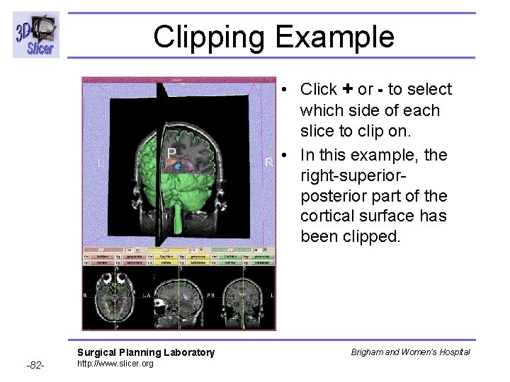 Clipping Example • Click + or - to select which side of each slice Clipping Example • Click + or - to select which side of each slice