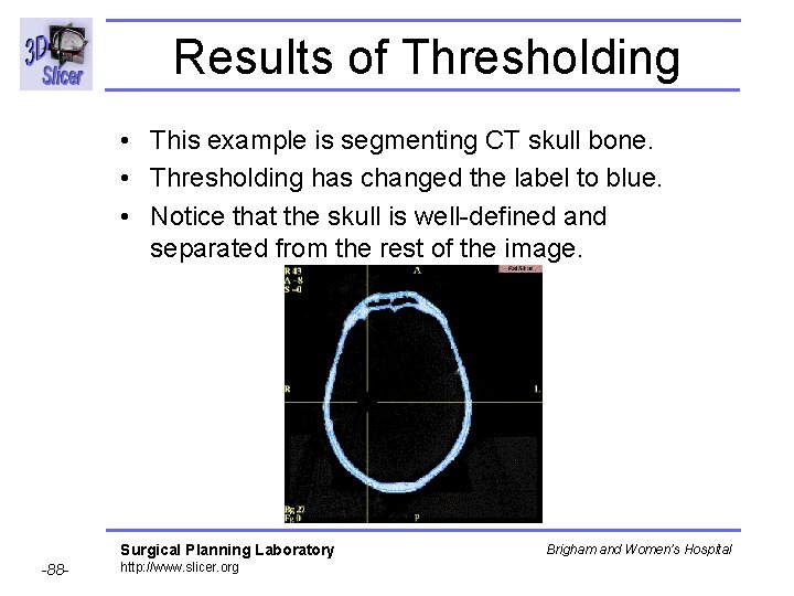Results of Thresholding • This example is segmenting CT skull bone. • Thresholding has Results of Thresholding • This example is segmenting CT skull bone. • Thresholding has