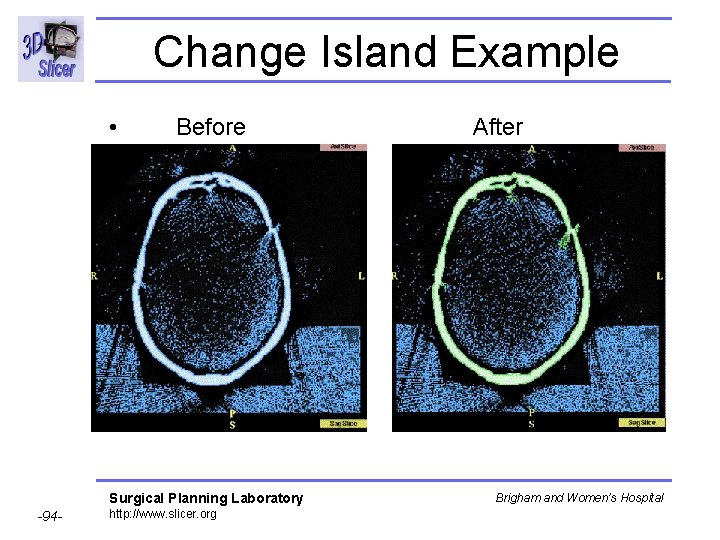 Change Island Example • Before After Surgical Planning Laboratory -94 - http: //www. slicer. Change Island Example • Before After Surgical Planning Laboratory -94 - http: //www. slicer.