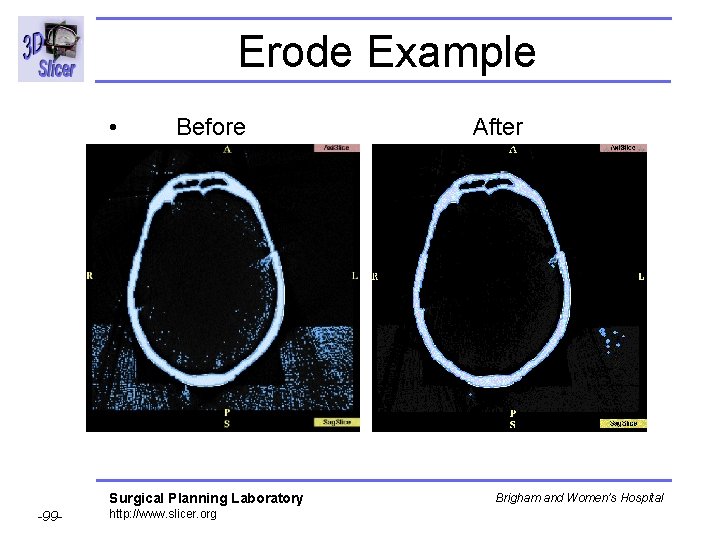 Erode Example • Before After Surgical Planning Laboratory -99 - http: //www. slicer. org Erode Example • Before After Surgical Planning Laboratory -99 - http: //www. slicer. org