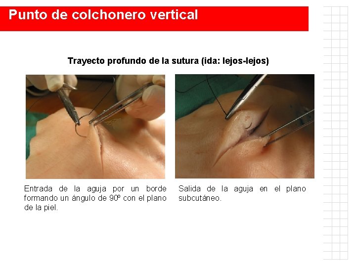 Punto de colchonero vertical Trayecto profundo de la sutura (ida: lejos-lejos) Entrada de la