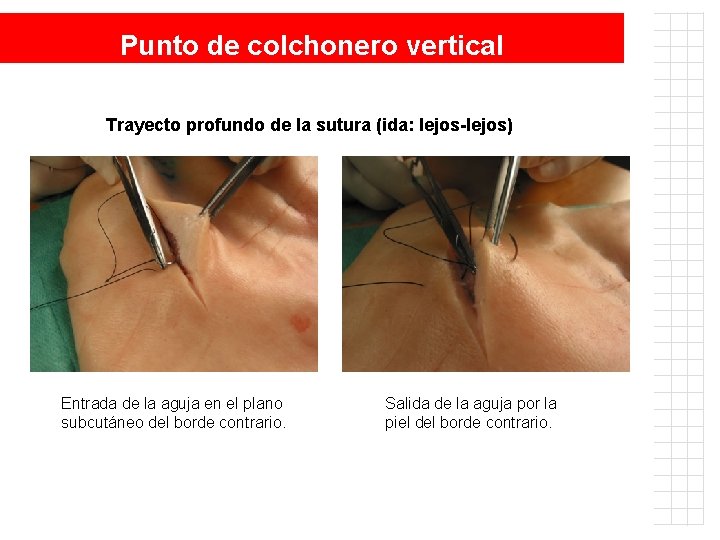 Punto de colchonero vertical Trayecto profundo de la sutura (ida: lejos-lejos) Entrada de la