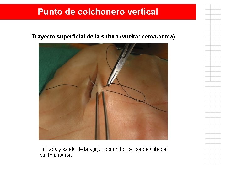Punto de colchonero vertical Trayecto superficial de la sutura (vuelta: cerca-cerca) Entrada y salida
