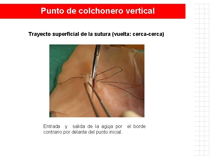 Punto de colchonero vertical Trayecto superficial de la sutura (vuelta: cerca-cerca) Entrada y salida