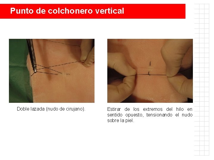 Punto de colchonero vertical Doble lazada (nudo de cirujano). Estirar de los extremos del