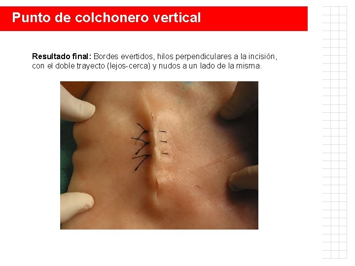 Punto de colchonero vertical Resultado final: Bordes evertidos, hilos perpendiculares a la incisión, con