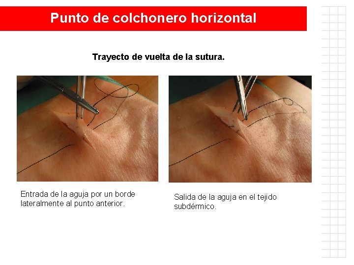 Punto de colchonero horizontal T Trayecto de vuelta de la sutura. Entrada de la