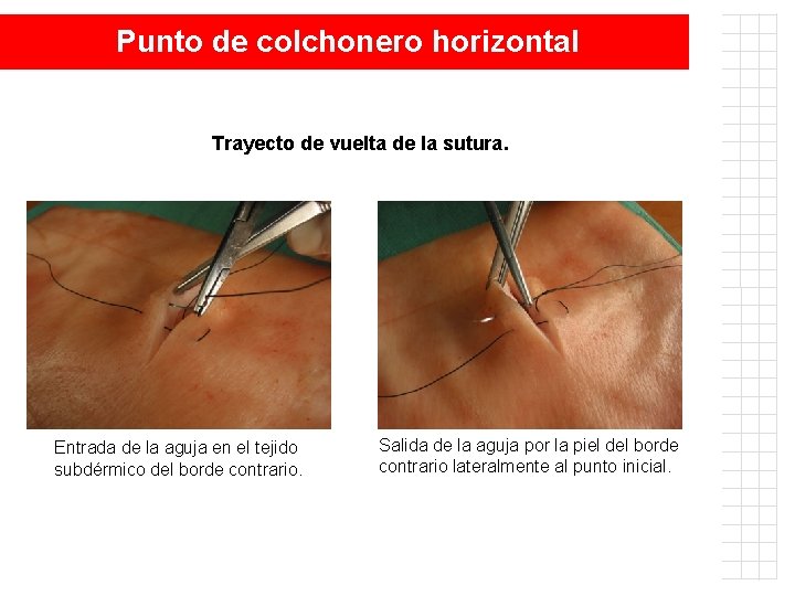 Punto de colchonero horizontal Trayecto de vuelta de la sutura. Entrada de la aguja