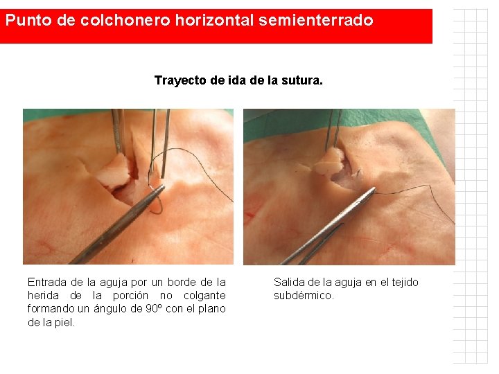 Punto de colchonero horizontal semienterrado Trayecto de ida de la sutura. Entrada de la