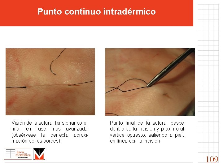 Punto continuo intradérmico Visión de la sutura, tensionando el hilo, en fase más avanzada