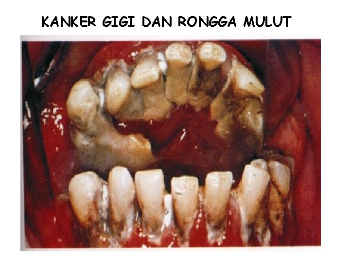 KANKER GIGI DAN RONGGA MULUT 