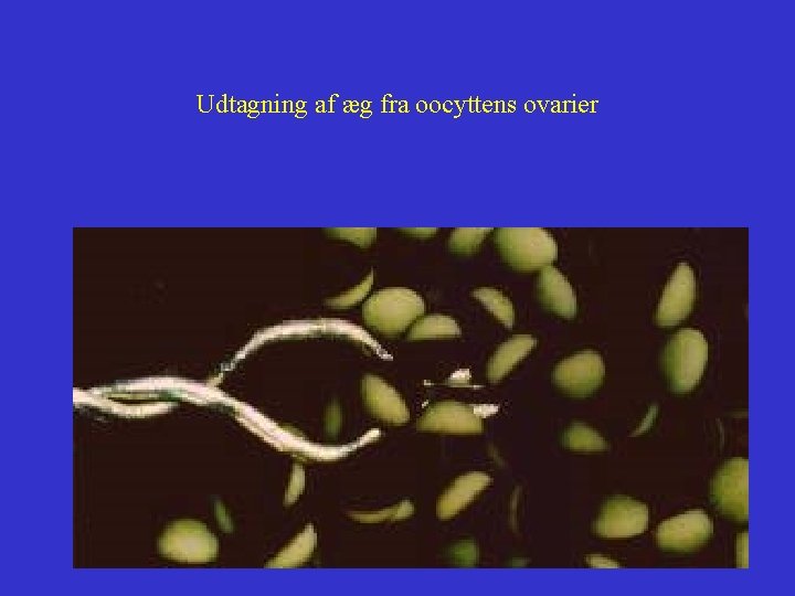 Udtagning af æg fra oocyttens ovarier Udtagning af æg fra oocyttens ovarier