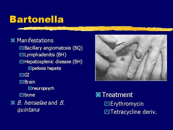 Bartonella z Manifestations y Bacillary angiomatosis (BQ) y Lymphadenitis (BH) y Hepatosplenic disease (BH)