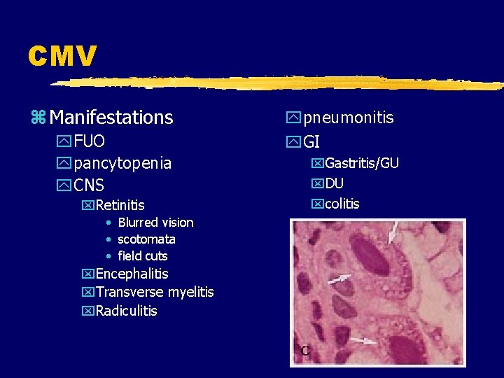 CMV z Manifestations y. FUO ypancytopenia y. CNS x. Retinitis • Blurred vision •