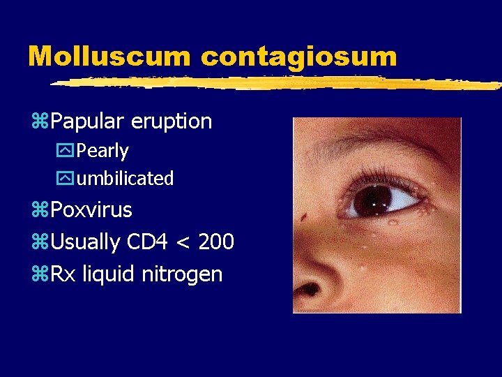 Molluscum contagiosum z. Papular eruption y. Pearly yumbilicated z. Poxvirus z. Usually CD 4