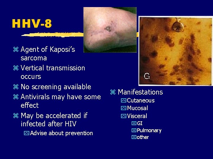 HHV-8 z Agent of Kaposi’s sarcoma z Vertical transmission occurs z No screening available