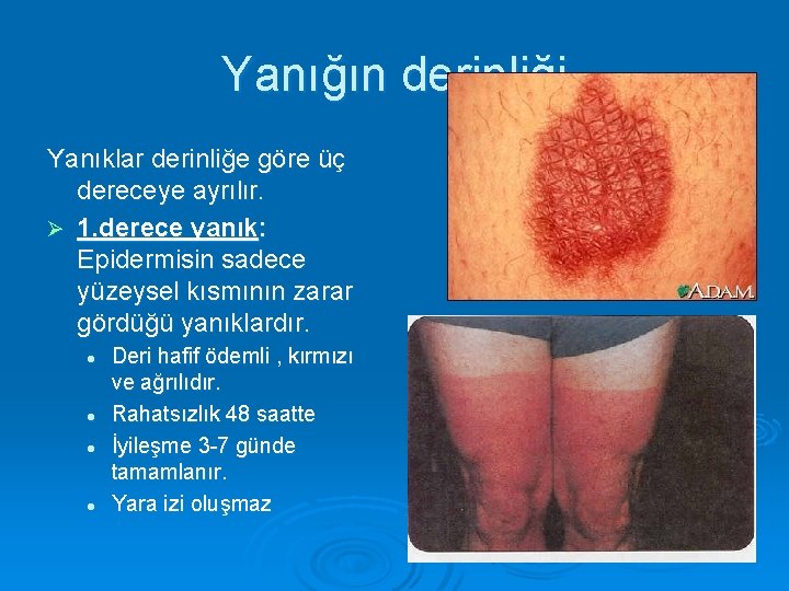 Yanığın derinliği Yanıklar derinliğe göre üç dereceye ayrılır. Ø 1. derece yanık: Epidermisin sadece