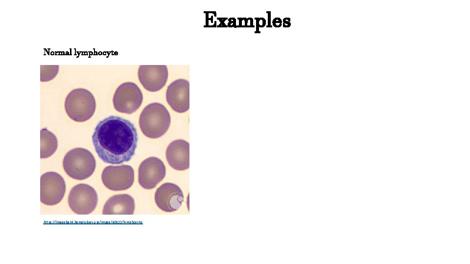 Normal lymphocyte https: //imagebank. hematology. org/image/60511/lymphocyte Examples 
