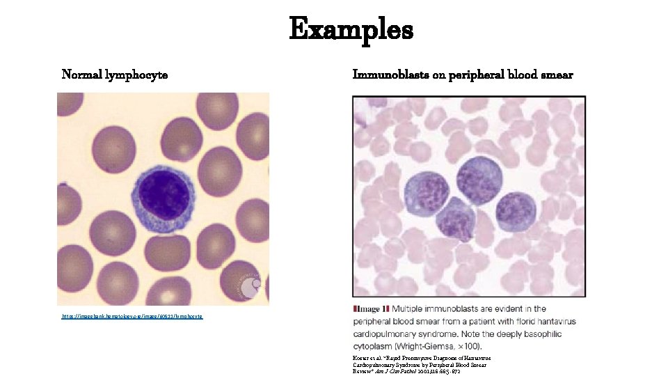 Normal lymphocyte Examples Immunoblasts on peripheral blood smear https: //imagebank. hematology. org/image/60511/lymphocyte Koster et