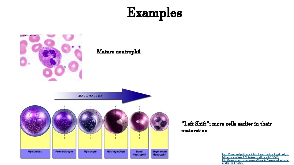 Examples Mature neutrophil “Left Shift”; more cells earlier in their maturation https: //www. pathpedia.