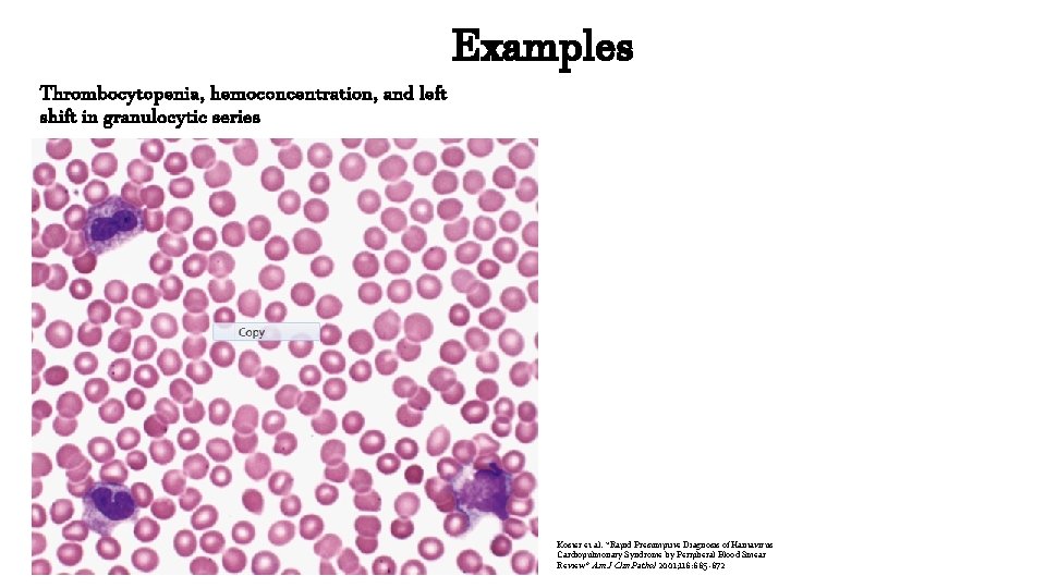 Thrombocytopenia, hemoconcentration, and left shift in granulocytic series Examples Koster et al. “Rapid Presumptive