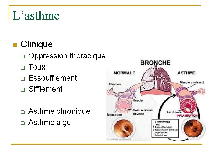 L’asthme n Clinique q q q Oppression thoracique Toux Essoufflement Sifflement Asthme chronique Asthme
