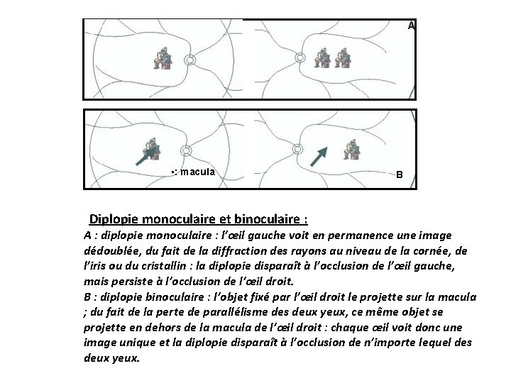 A • : macula Diplopie monoculaire et binoculaire : B A : diplopie monoculaire