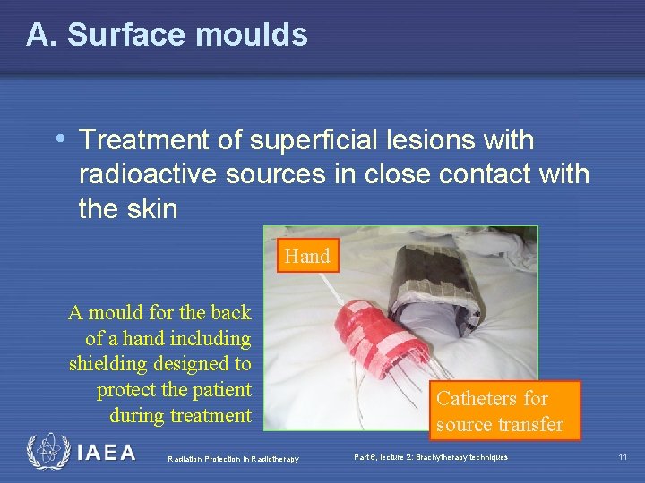 A. Surface moulds • Treatment of superficial lesions with radioactive sources in close contact