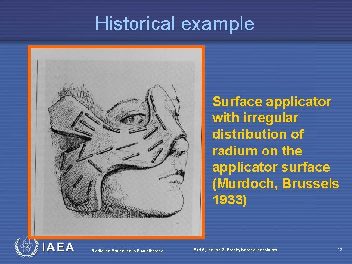 Historical example Surface applicator with irregular distribution of radium on the applicator surface (Murdoch,