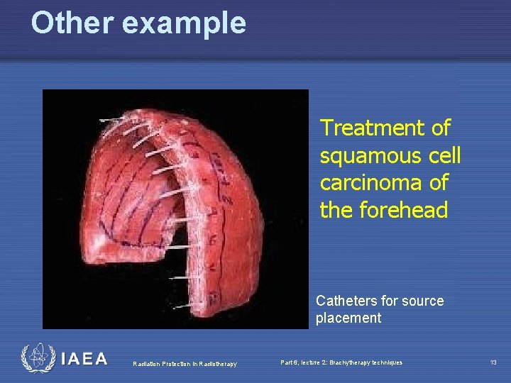 Other example Treatment of squamous cell carcinoma of the forehead Catheters for source placement
