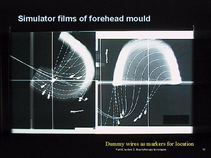 Simulator films of forehead mould Dummy wires as markers for location Part 6, lecture
