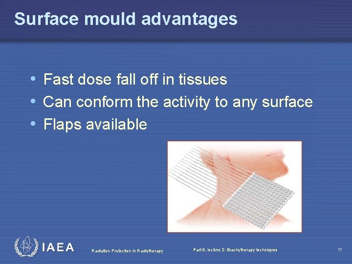 Surface mould advantages • Fast dose fall off in tissues • Can conform the