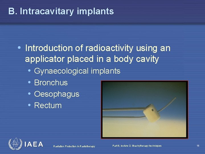 B. Intracavitary implants • Introduction of radioactivity using an applicator placed in a body