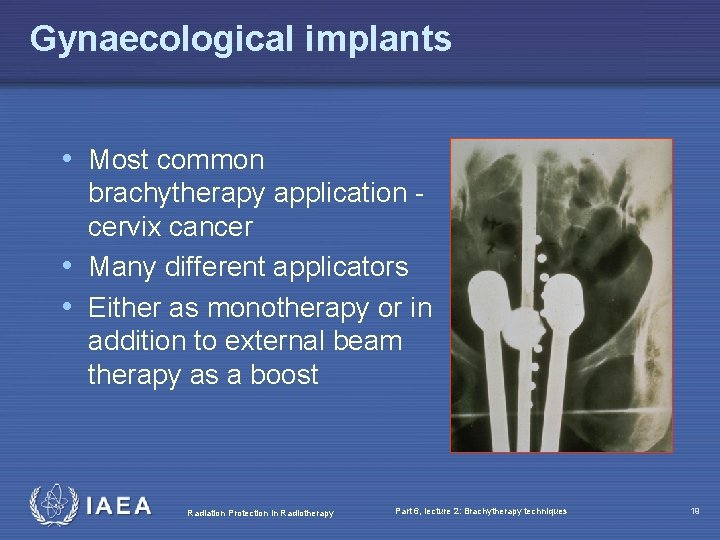 Gynaecological implants • Most common brachytherapy application cervix cancer • Many different applicators •