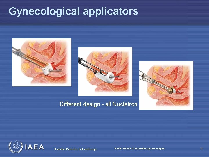 Gynecological applicators Different design - all Nucletron Radiation Protection in Radiotherapy Part 6, lecture