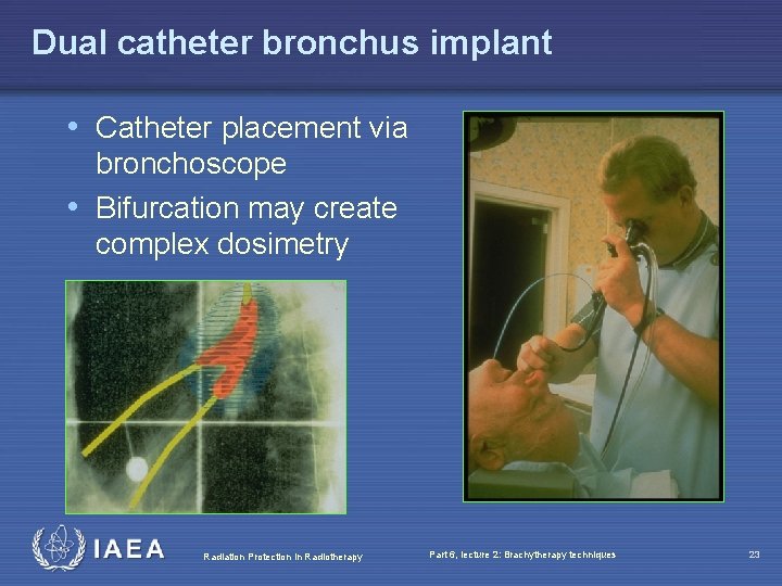 Dual catheter bronchus implant • Catheter placement via bronchoscope • Bifurcation may create complex