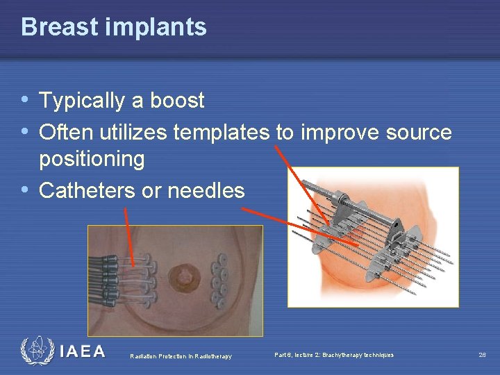 Breast implants • Typically a boost • Often utilizes templates to improve source positioning