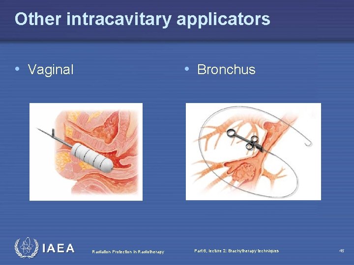 Other intracavitary applicators • Vaginal • Bronchus Radiation Protection in Radiotherapy Part 6, lecture