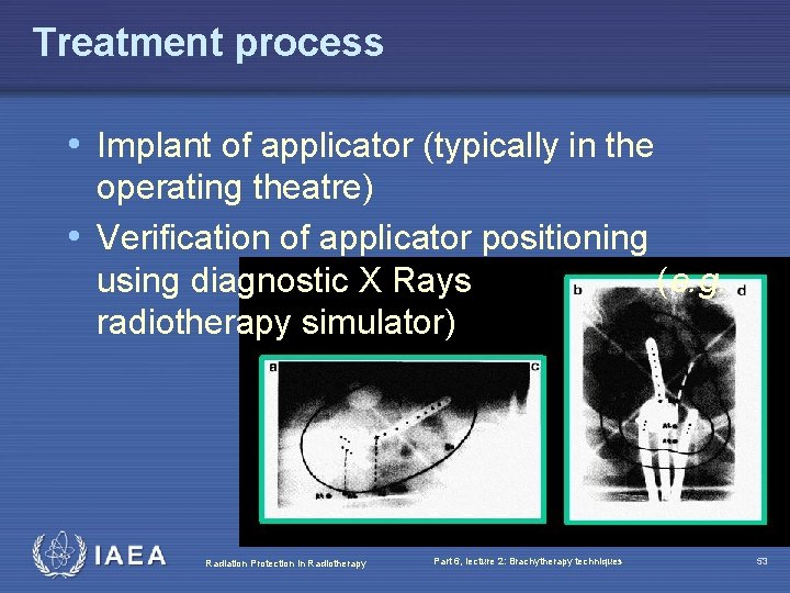 Treatment process • Implant of applicator (typically in the operating theatre) • Verification of
