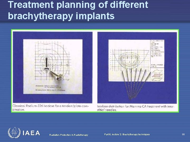 Treatment planning of different brachytherapy implants Radiation Protection in Radiotherapy Part 6, lecture 2: