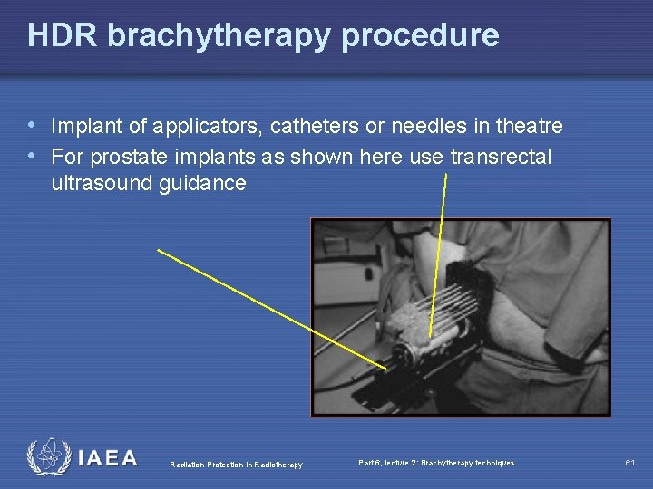 HDR brachytherapy procedure • Implant of applicators, catheters or needles in theatre • For
