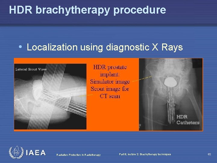 HDR brachytherapy procedure • Localization using diagnostic X Rays Radiation Protection in Radiotherapy Part