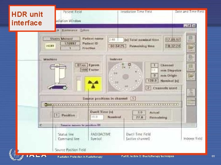 HDR unit interface Radiation Protection in Radiotherapy Part 6, lecture 2: Brachytherapy techniques 65
