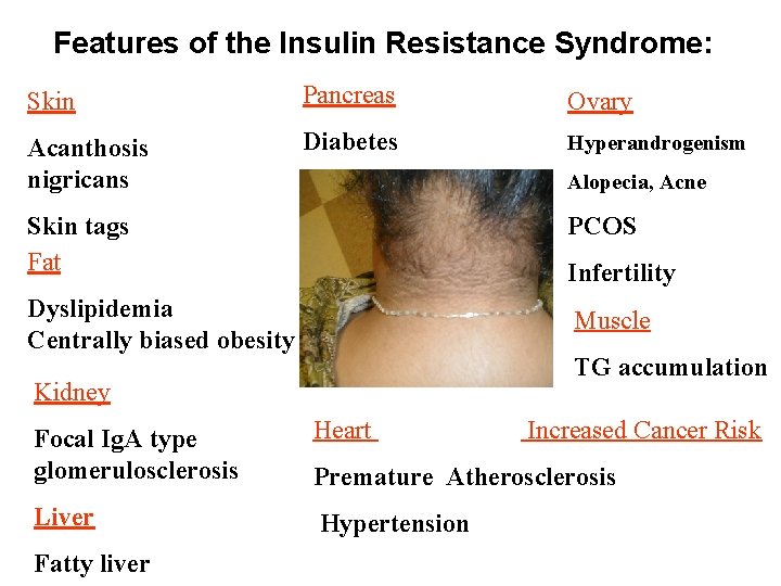 Features of the Insulin Resistance Syndrome: Skin Pancreas Ovary Acanthosis nigricans Diabetes Hyperandrogenism Alopecia,
