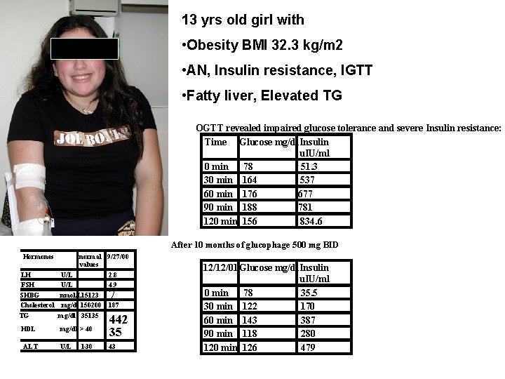  13 yrs old girl with • Obesity BMI 32. 3 kg/m 2 •