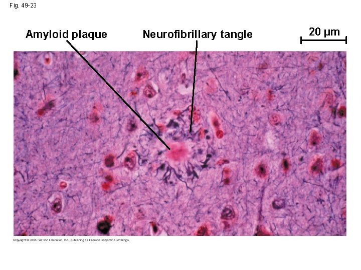 Fig. 49 -23 Amyloid plaque Neurofibrillary tangle 20 µm 