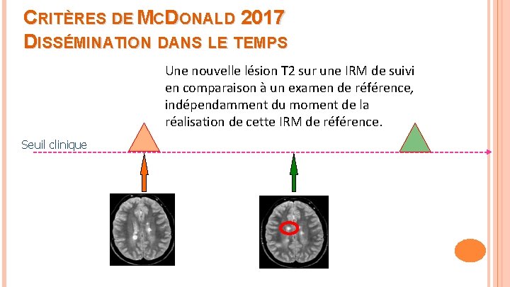 CRITÈRES DE MCDONALD 2017 DISSÉMINATION DANS LE TEMPS Une nouvelle lésion T 2 sur