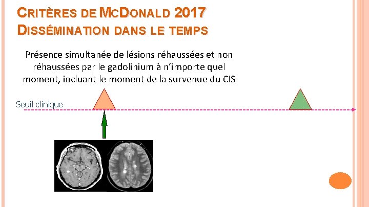 CRITÈRES DE MCDONALD 2017 DISSÉMINATION DANS LE TEMPS Présence simultanée de lésions réhaussées et