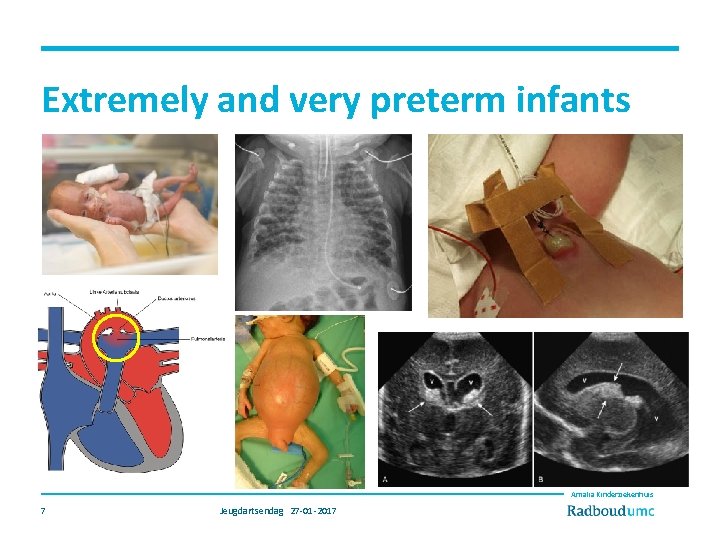 Extremely and very preterm infants Amalia Kinderziekenhuis 7 Jeugdartsendag 27 -01 -2017 